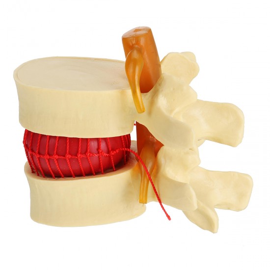 Anatomical Human Skeleton Spine Lumbar Vertebrae Degenerative Disc Medical Model