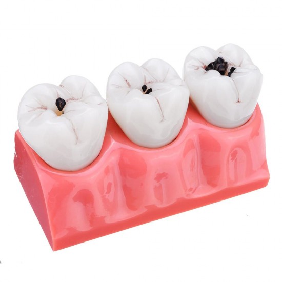 4X Detachable Human Dental Caries Teeth Tooth Decay Comparison Model Pathology Patient Education Medical Model