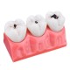 4X Detachable Human Dental Caries Teeth Tooth Decay Comparison Model Pathology Patient Education Medical Model