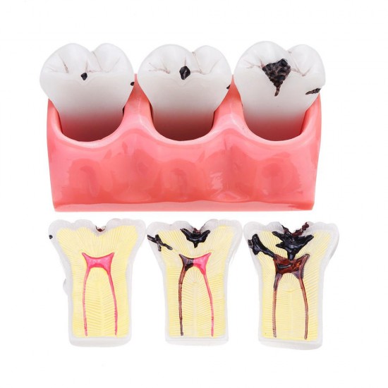 4X Detachable Human Dental Caries Teeth Tooth Decay Comparison Model Pathology Patient Education Medical Model