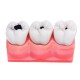 4X Detachable Human Dental Caries Teeth Tooth Decay Comparison Model Pathology Patient Education Medical Model