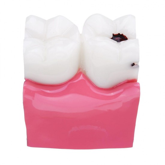6X Human Dental Caries Teeth Tooth Decay Two-Side Comparison Model Pathology Patient Education Medical Model