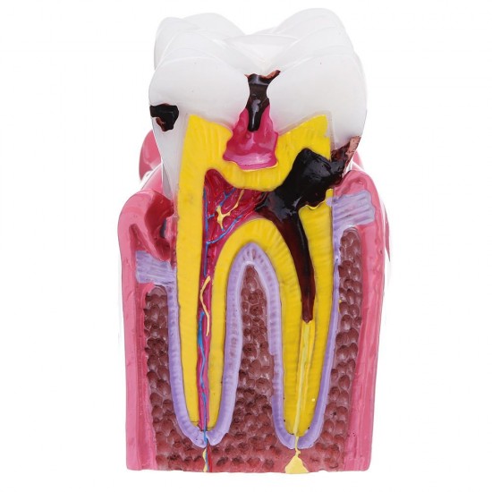6X Human Dental Caries Teeth Tooth Decay Two-Side Comparison Model Pathology Patient Education Medical Model