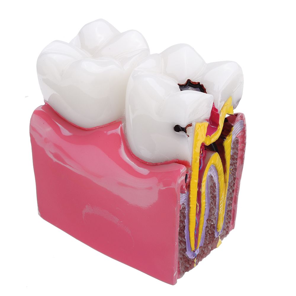 6X-Human-Dental-Caries-Teeth-Tooth-Decay-Two-Side-Comparison-Model-Pathology-Patient-Education-Medic-1473539
