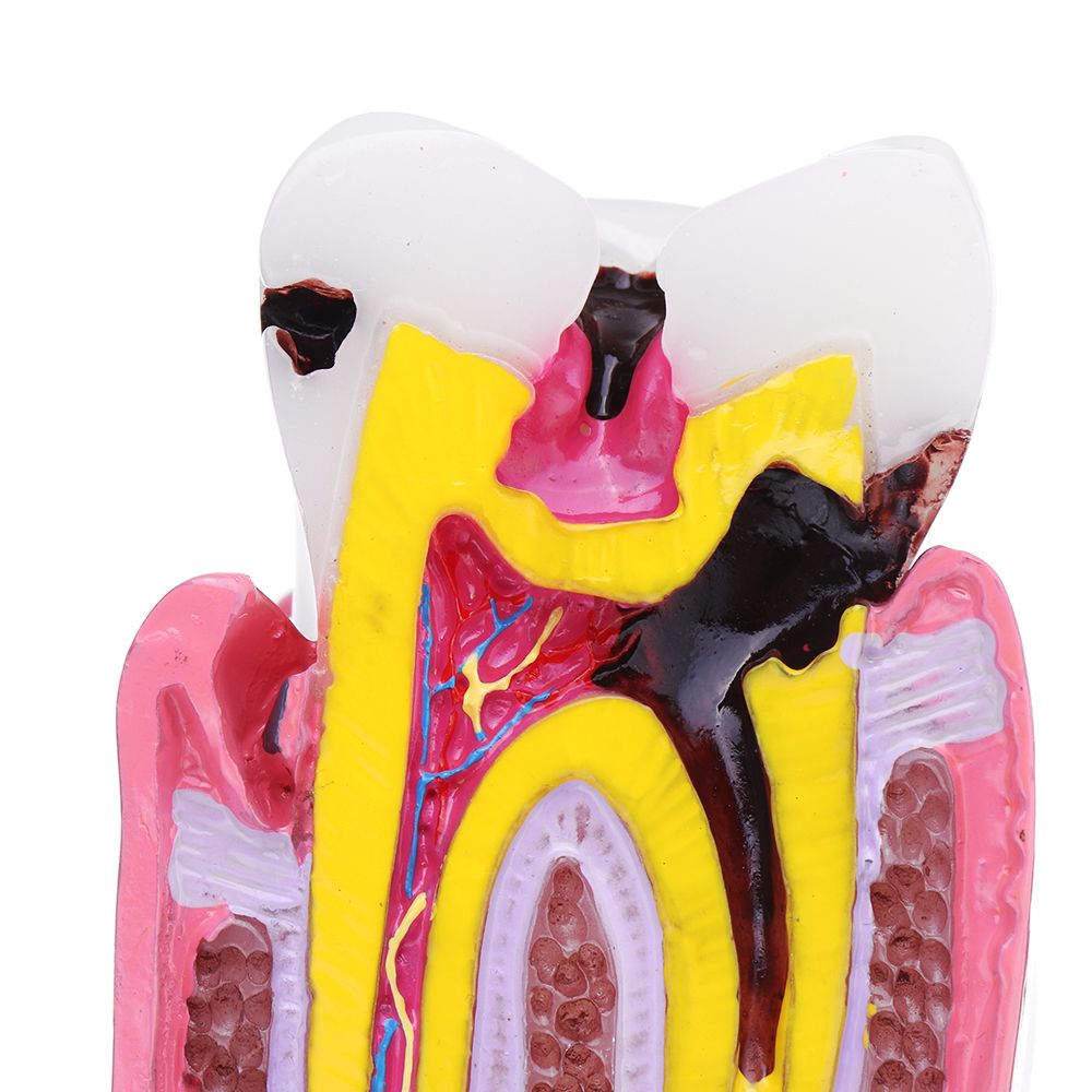 6X-Human-Dental-Caries-Teeth-Tooth-Decay-Two-Side-Comparison-Model-Pathology-Patient-Education-Medic-1473539